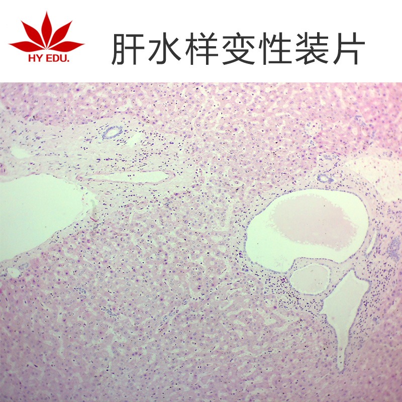 肝水样变性装片  高教标准 显微镜玻片 病理组织细胞 生物切片 成像清晰