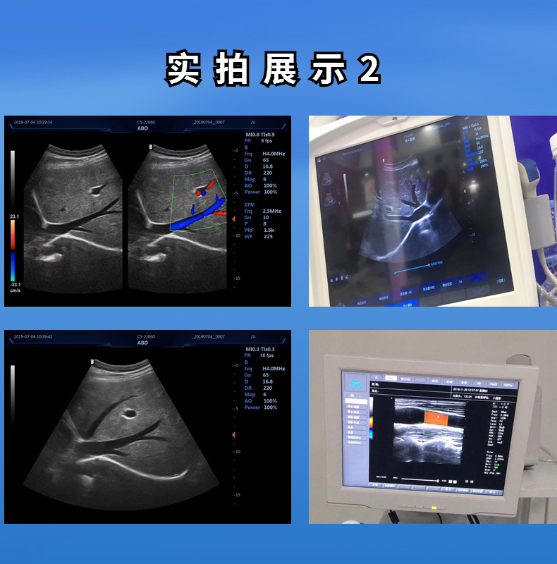 江苏徐州新玛彩超机器孕检产检B超机器胎心仪
